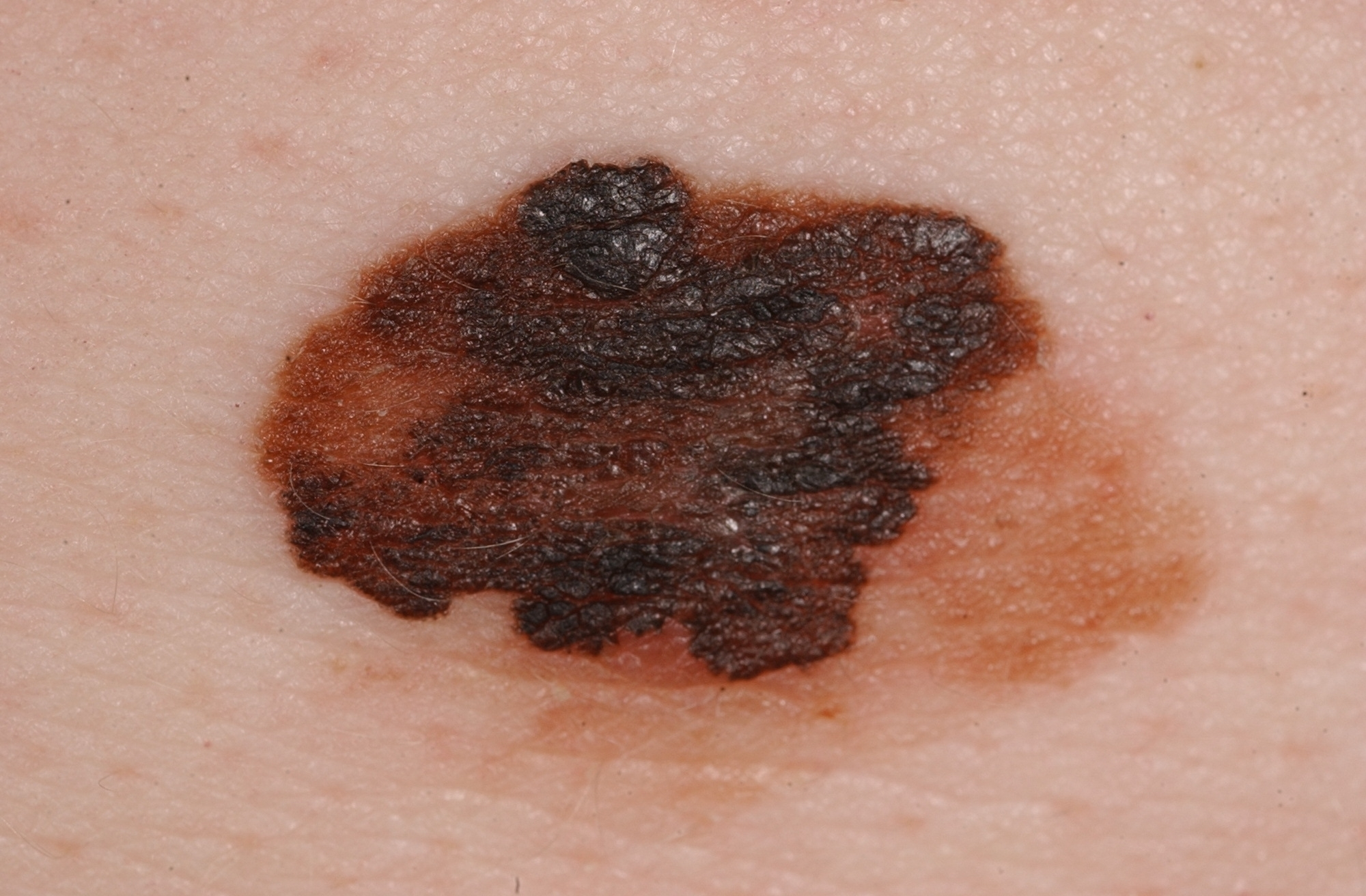 Melanom türü cilt kanserinin dermatoskopik görüntüsü – İzmir Dermatolog Dr. Sedef Demirer