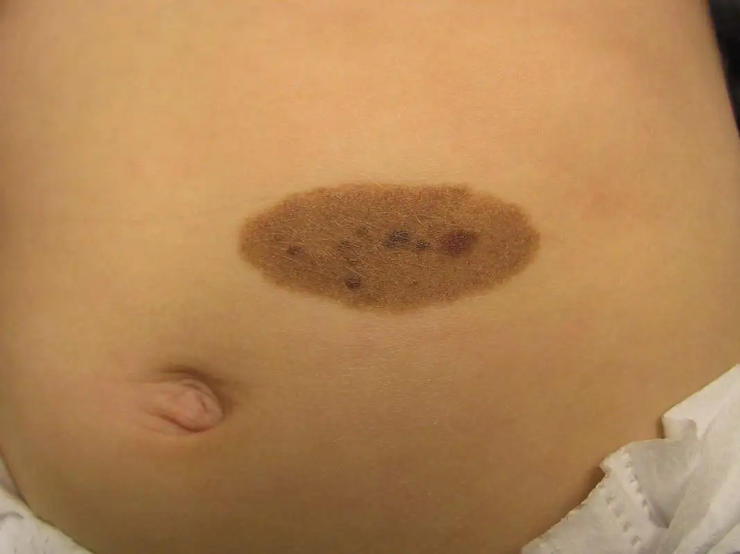 Konjenital nevüs (doğumsal ben) dermatoskopik görünümü – İzmir Dermatolog Dr. Sedef Demirer