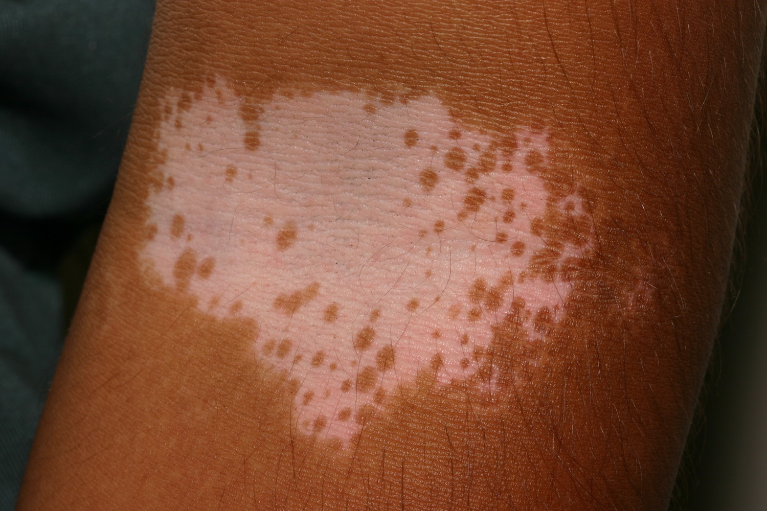 Vitiligo nedir beyaz cilt lekeleri