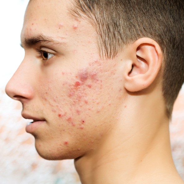 Acne treatment in Izmir with assessment of adult acne, skin barrier, hormonal clues and scar risk before a personalised medical plan