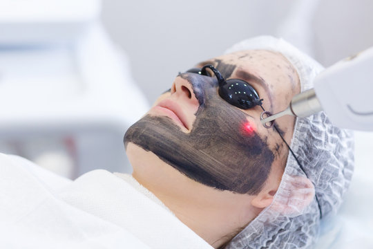 Carbon laser peel in Izmir for pores, oiliness and skin rejuvenation after dermatologist assessment by Dr. Sedef Demirer