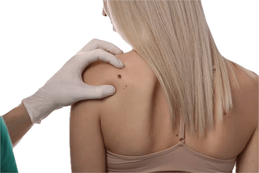 Laser-Nävus-Entfernung in Izmir nach dermatologischer Untersuchung und Beurteilung der Eignung bei Dr. Sedef Demirer