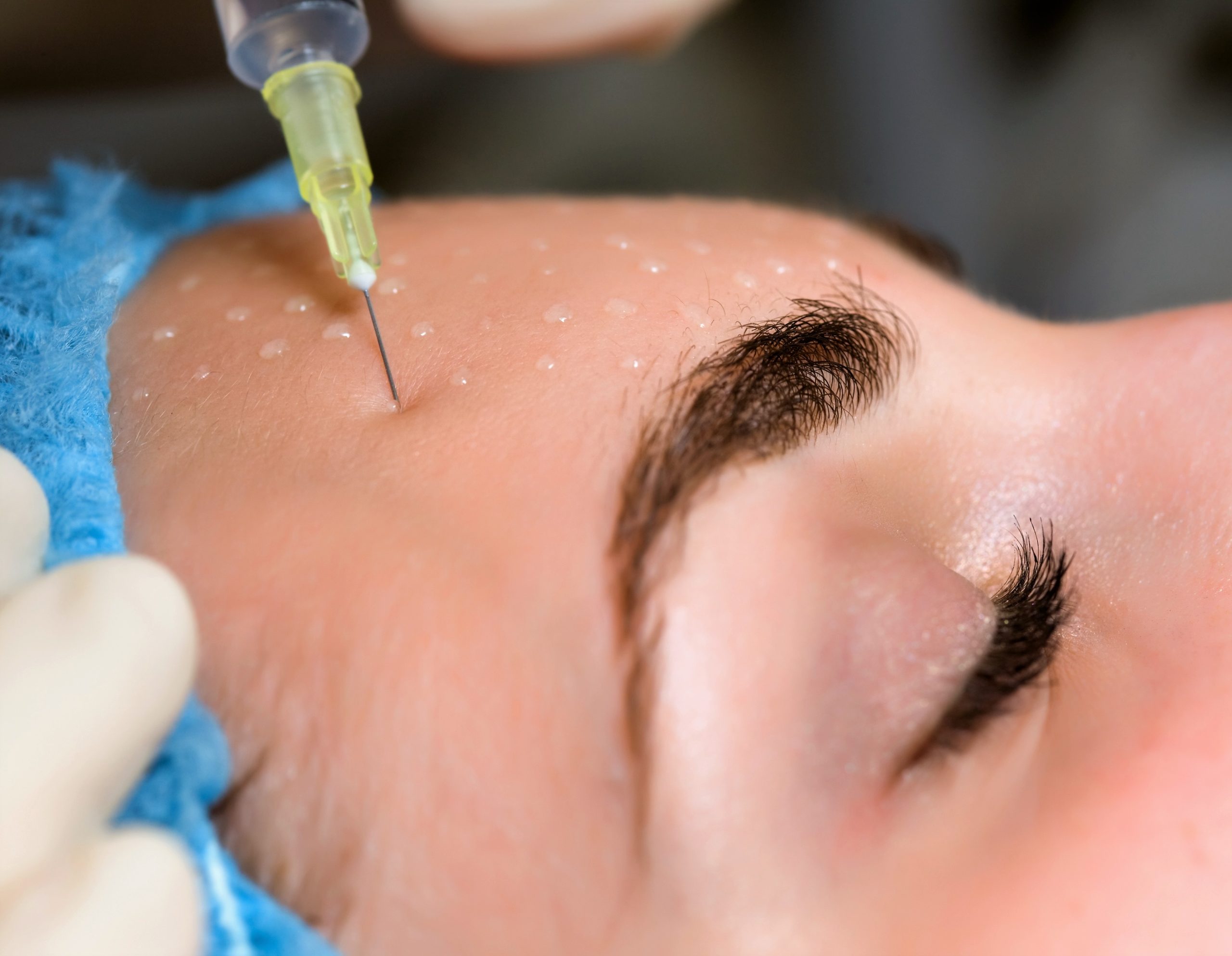 Mesotherapie in Izmir mit individueller dermatologischer Beurteilung und Behandlungsplanung bei Dr. Sedef Demirer