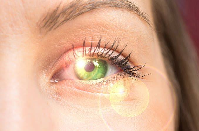 Under-eye filler in Izmir for tear trough hollowing after assessment of anatomy, swelling tendency and suitability by Dr. Sedef Demirer